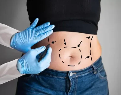 Maintaining a Positive Mindset During Liposuction surgery in Dubai