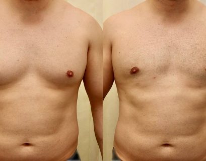 gynecomastia surgery abu dhabi