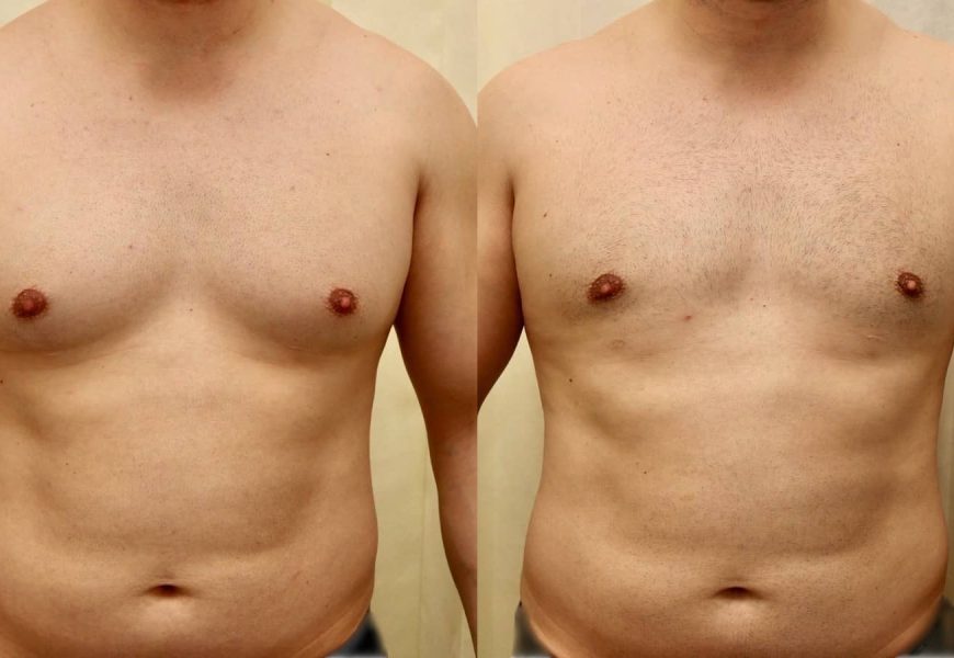 gynecomastia surgery abu dhabi