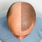 Hair Transplant in Riyadh