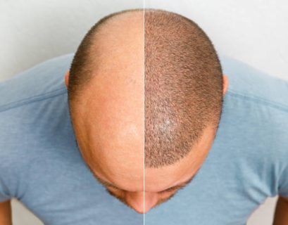 Hair Transplant in Riyadh