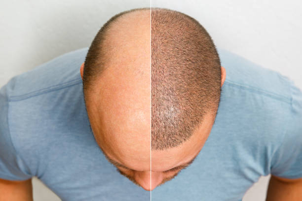 Hair Transplant in Riyadh