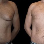 Before and After Male Breast Reduction Result