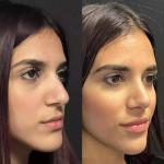 Exploring Nose Surgery in Dubai: What to Expect from Consultation to Results