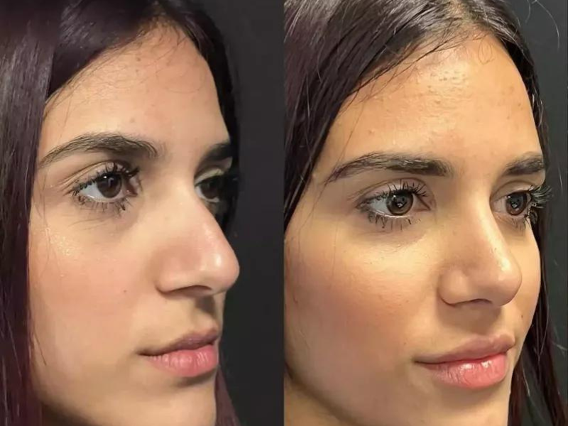 Exploring Nose Surgery in Dubai: What to Expect from Consultation to Results