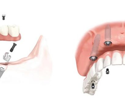 Could All on 4 Dental Implants Be the Solution You’ve Been Searching For